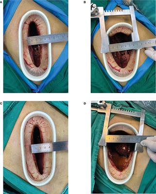 Would the width of a metal rib spreader affect postoperative pain in patients who undergo video-assisted mini-thoracotomy (VAMT)?